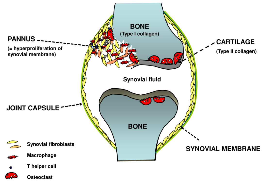 RA patients with synovitis, Ultrasound, MRI