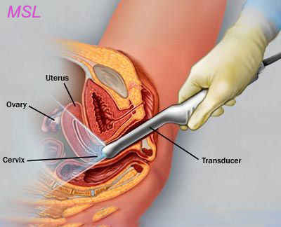 obstetric ultrasound