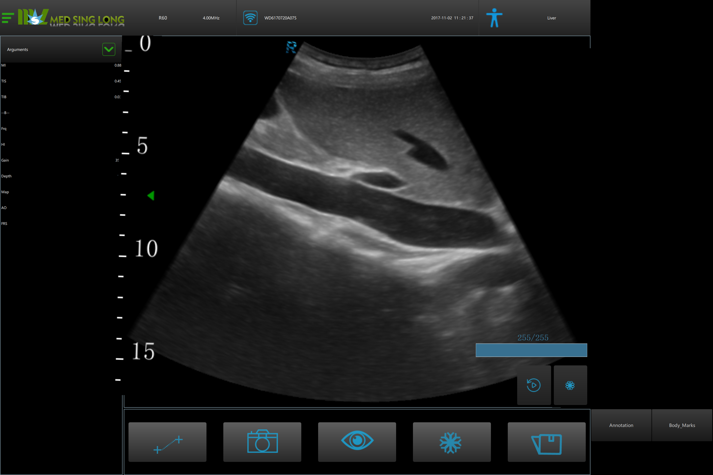 3D ultrasound