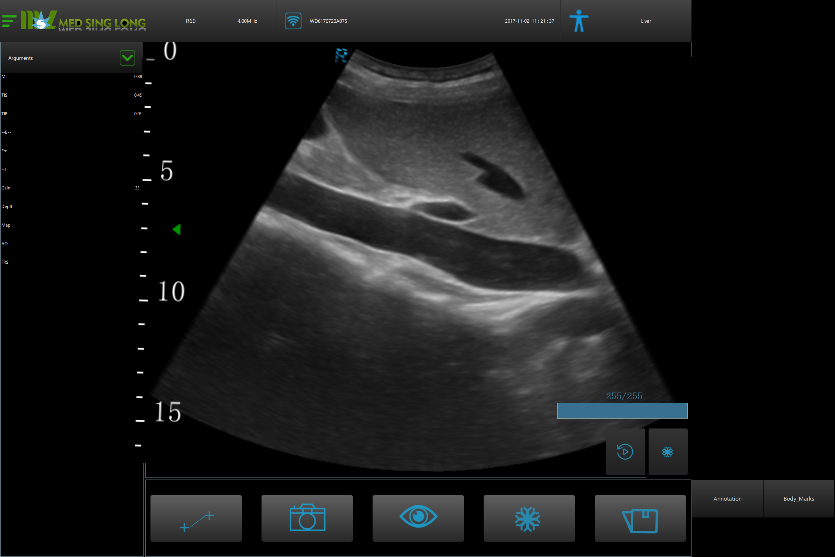 3D ultrasound 3D ultrasound